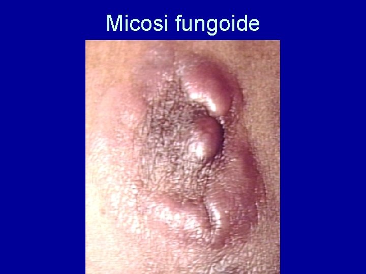 Micosi fungoide 