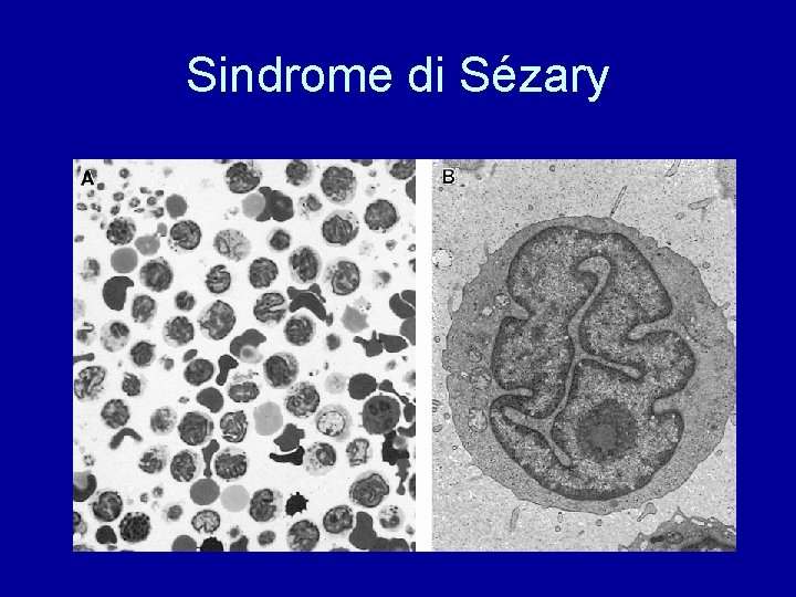 Sindrome di Sézary 