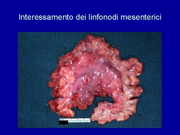 Interessamento dei linfonodi mesenterici 