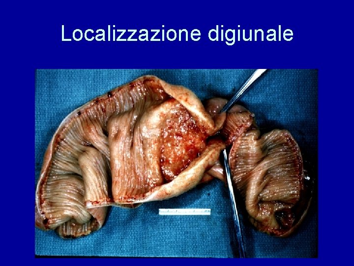 Localizzazione digiunale 