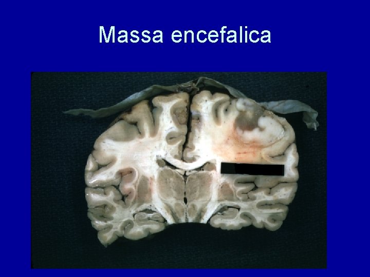 Massa encefalica 