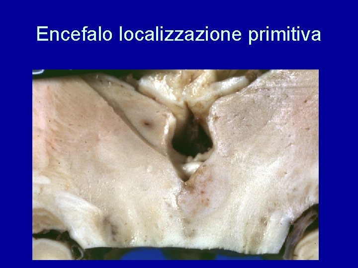 Encefalo localizzazione primitiva 