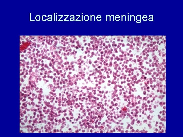 Localizzazione meningea 