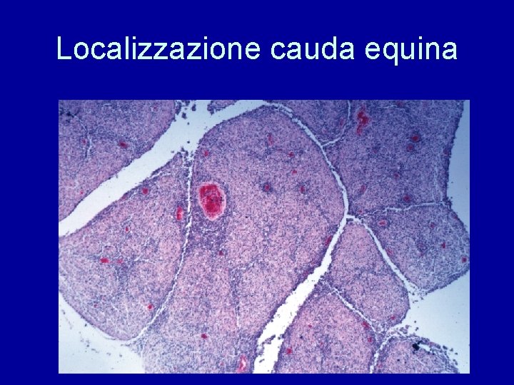 Localizzazione cauda equina 