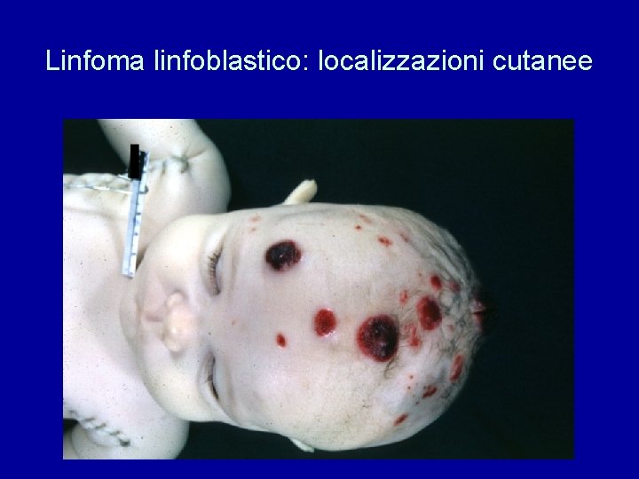 Linfoma linfoblastico: localizzazioni cutanee 