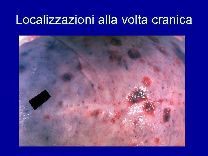 Localizzazioni alla volta cranica 