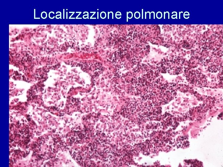 Localizzazione polmonare 