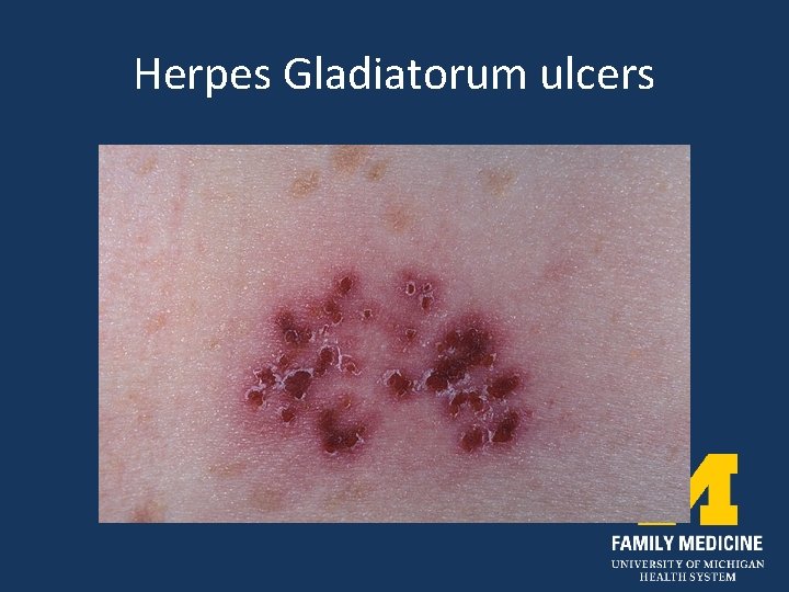 Herpes Gladiatorum ulcers 