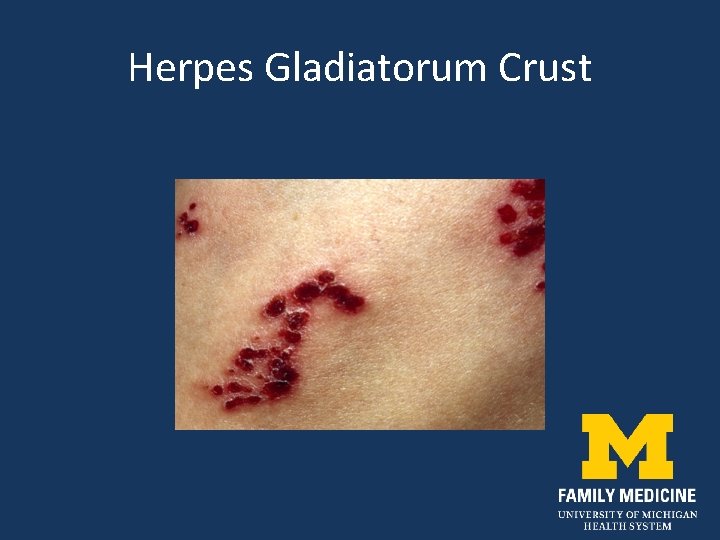 Herpes Gladiatorum Crust 