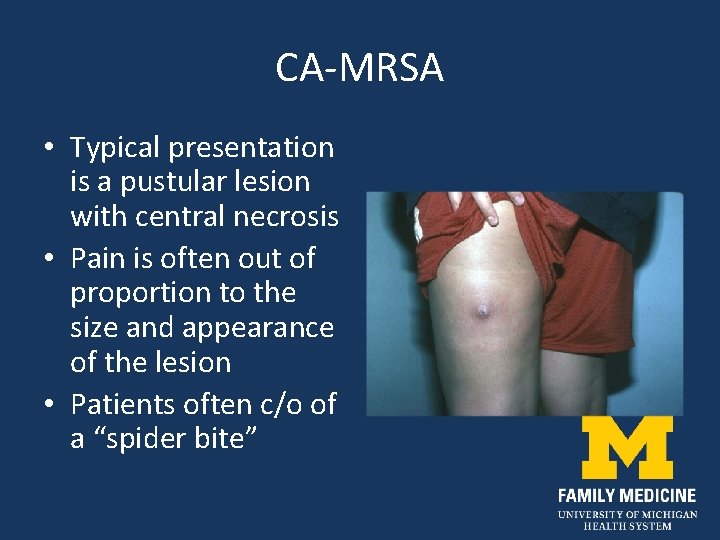 CA-MRSA • Typical presentation is a pustular lesion with central necrosis • Pain is
