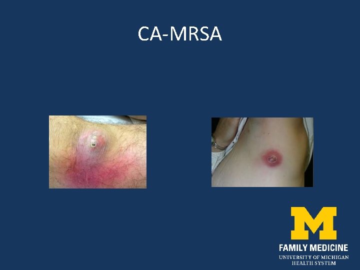 CA-MRSA 