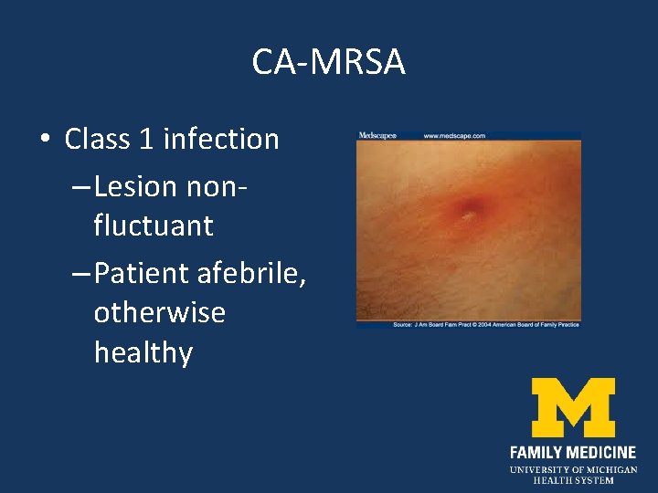 CA-MRSA • Class 1 infection – Lesion nonfluctuant – Patient afebrile, otherwise healthy 