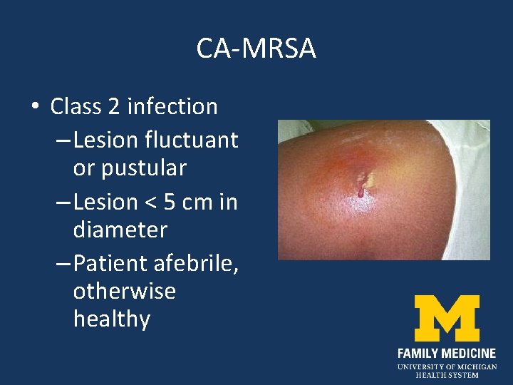 CA-MRSA • Class 2 infection – Lesion fluctuant or pustular – Lesion < 5