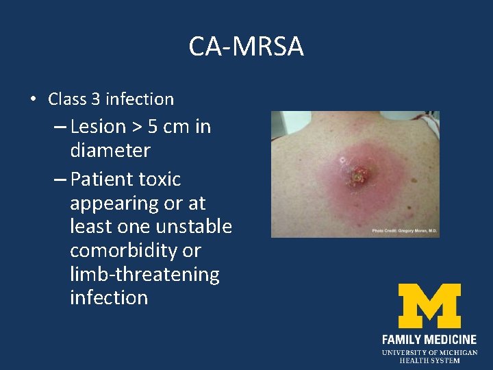 CA-MRSA • Class 3 infection – Lesion > 5 cm in diameter – Patient