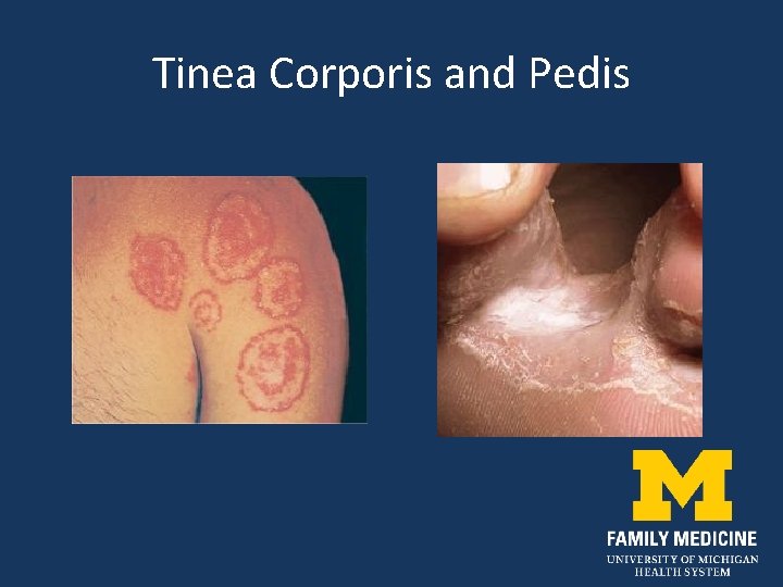 Tinea Corporis and Pedis 