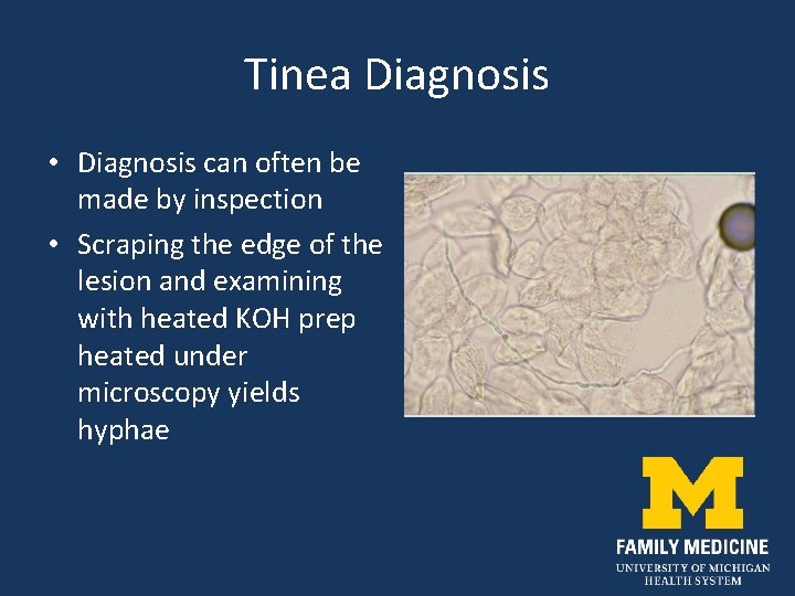Tinea Diagnosis • Diagnosis can often be made by inspection • Scraping the edge