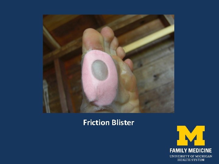 Friction Blister 