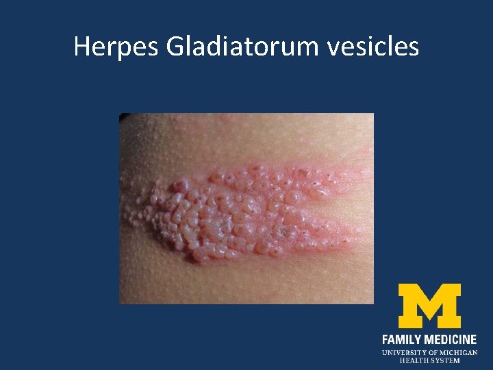 Herpes Gladiatorum vesicles 