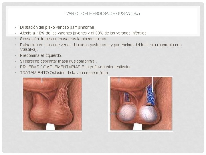 VARICOCELE «BOLSA DE GUSANOS» ) • • Dilatación del plexo venoso pampiniforme. Afecta al