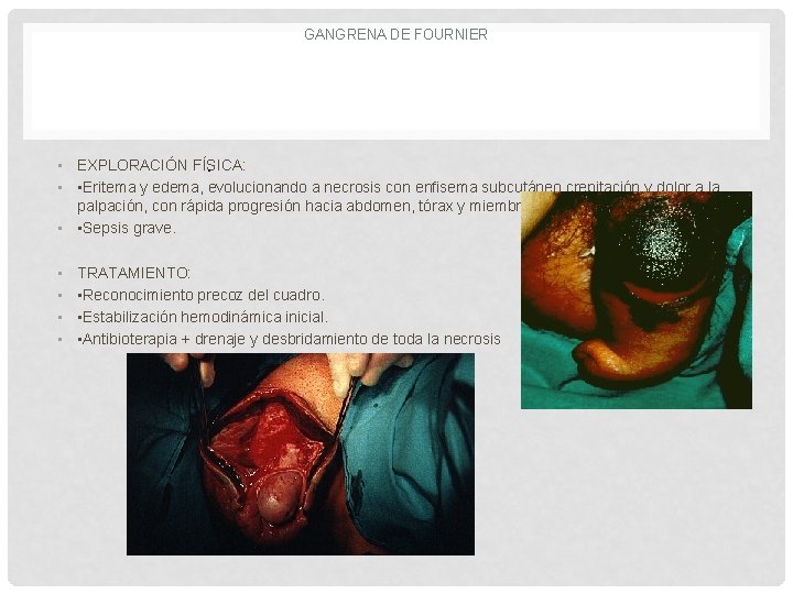 GANGRENA DE FOURNIER • EXPLORACIÓN FÍSICA: . • • Eritema y edema, evolucionando a