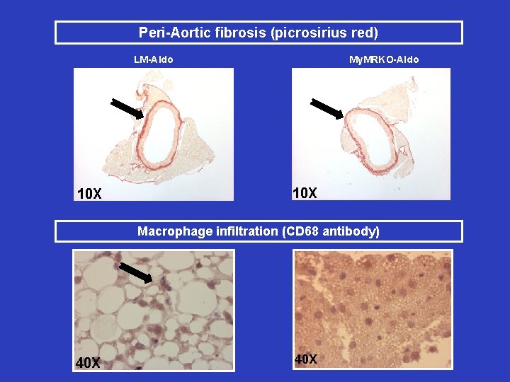 Peri-Aortic fibrosis (picrosirius red) My. MRKO-Aldo LM-Aldo 10 X Macrophage infiltration (CD 68 antibody)