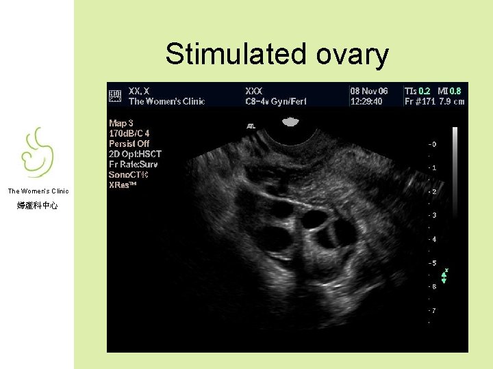 Stimulated ovary The Women’s Clinic 婦產科中心 