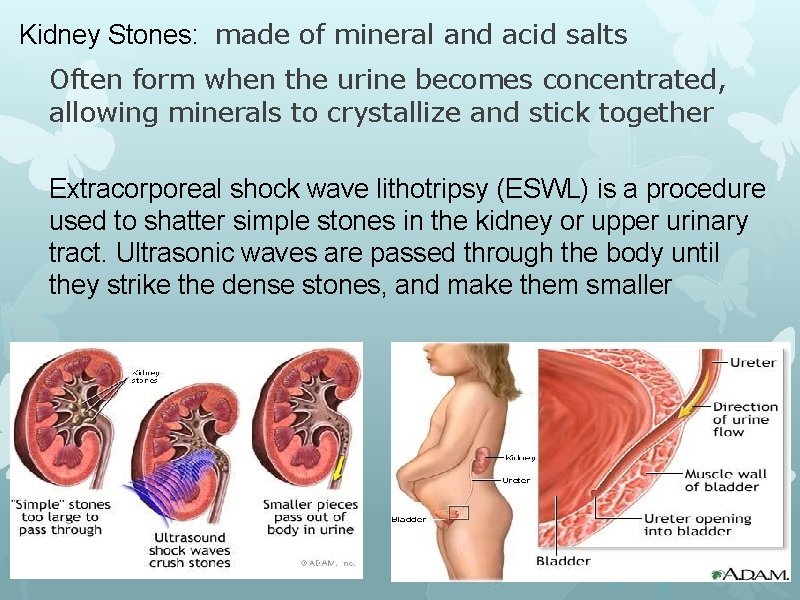 Kidney Stones: made of mineral and acid salts Often form when the urine becomes