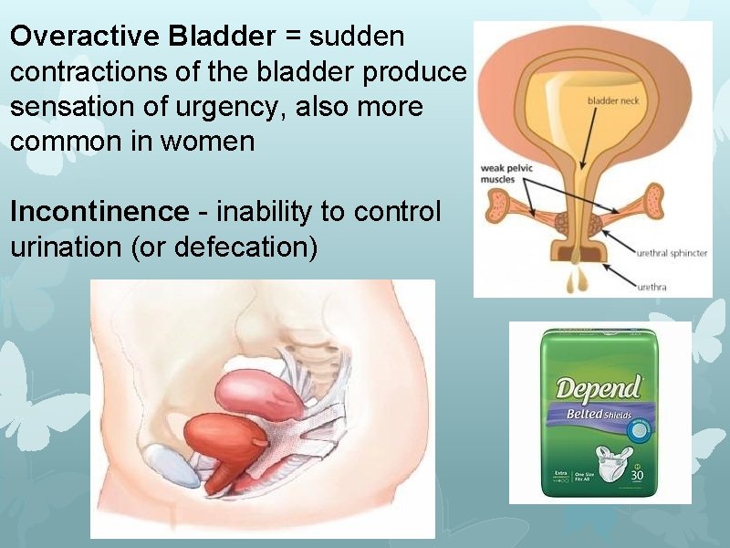 Overactive Bladder = sudden contractions of the bladder produce sensation of urgency, also more