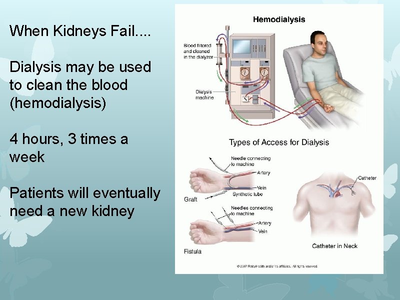 When Kidneys Fail. . Dialysis may be used to clean the blood (hemodialysis) 4