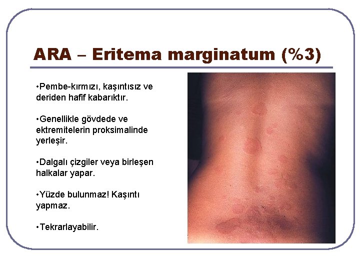 ARA – Eritema marginatum (%3) • Pembe-kırmızı, kaşıntısız ve deriden hafif kabarıktır. • Genellikle ARA – Eritema marginatum (%3) • Pembe-kırmızı, kaşıntısız ve deriden hafif kabarıktır. • Genellikle
