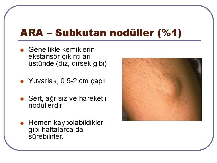 ARA – Subkutan nodüller (%1) l Genellikle kemiklerin ekstansör çıkıntıları üstünde (diz, dirsek gibi) ARA – Subkutan nodüller (%1) l Genellikle kemiklerin ekstansör çıkıntıları üstünde (diz, dirsek gibi)
