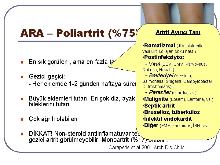 ARA – Poliartrit (%75) Artrit Ayırıcı Tanı • Romatizmal (JIA, sistemik vaskülit, kollajen doku ARA – Poliartrit (%75) Artrit Ayırıcı Tanı • Romatizmal (JIA, sistemik vaskülit, kollajen doku