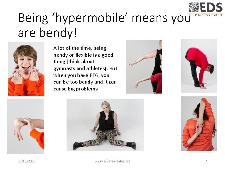 Being ‘hypermobile’ means you are bendy! A lot of the time, being bendy or Being ‘hypermobile’ means you are bendy! A lot of the time, being bendy or