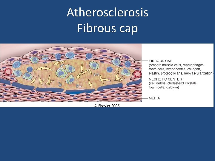 Atherosclerosis Fibrous cap 