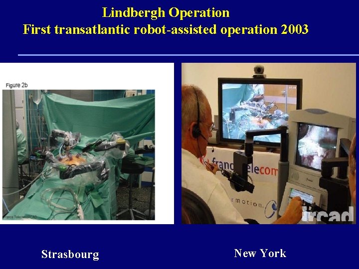 Lindbergh Operation First transatlantic robot-assisted operation 2003 Strasbourg New York 