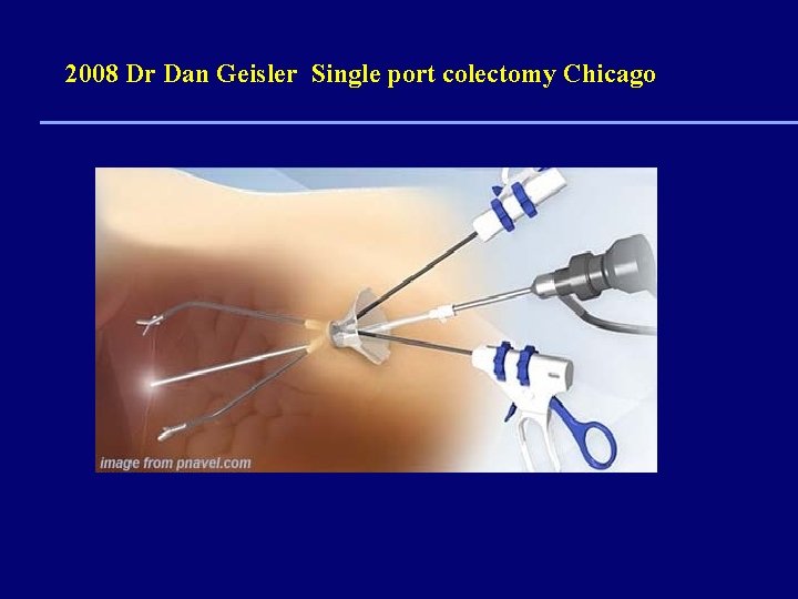 2008 Dr Dan Geisler Single port colectomy Chicago 