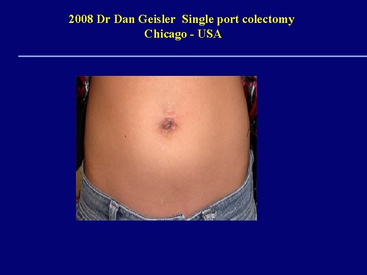 2008 Dr Dan Geisler Single port colectomy Chicago - USA 
