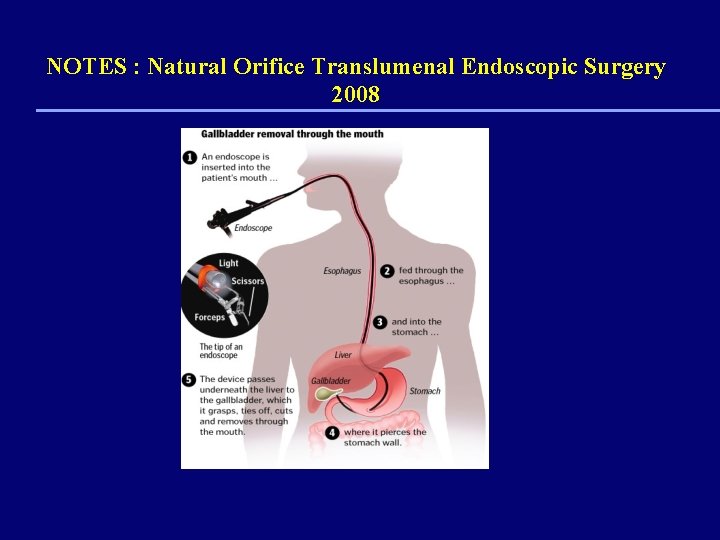 NOTES : Natural Orifice Translumenal Endoscopic Surgery 2008 