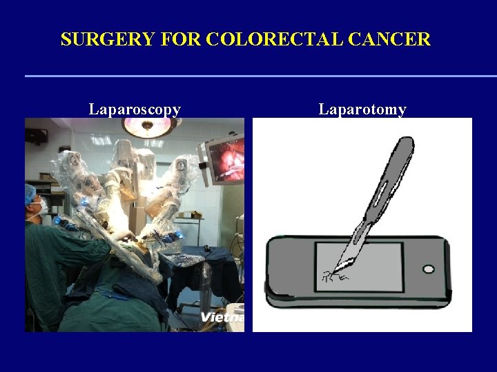 SURGERY FOR COLORECTAL CANCER Laparoscopy Laparotomy 