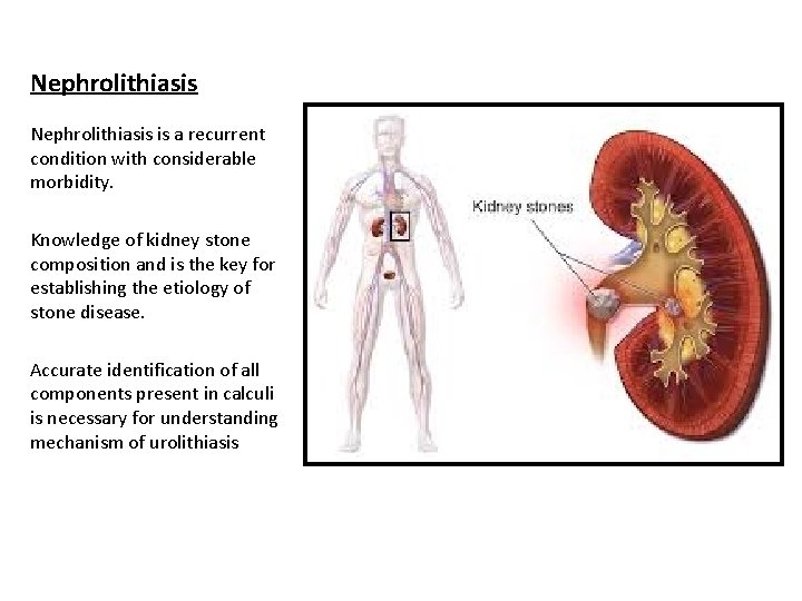Nephrolithiasis is a recurrent condition with considerable morbidity. Knowledge of kidney stone composition and Nephrolithiasis is a recurrent condition with considerable morbidity. Knowledge of kidney stone composition and