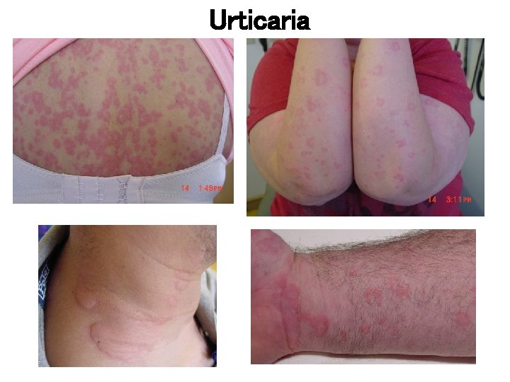 Urticaria 