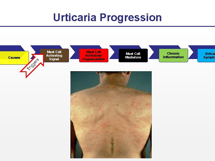 Urticaria Progression Tr ig ge rs Causes Mast Cell Activating Signal Mast Cell Activation/