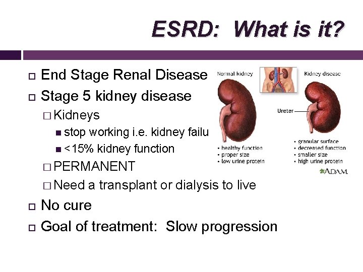 ESRD: What is it? End Stage Renal Disease Stage 5 kidney disease � Kidneys