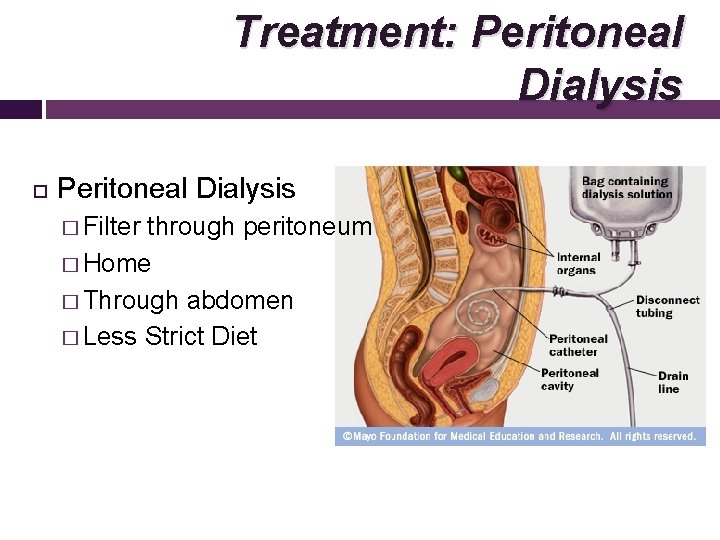 Treatment: Peritoneal Dialysis � Filter through peritoneum � Home � Through abdomen � Less