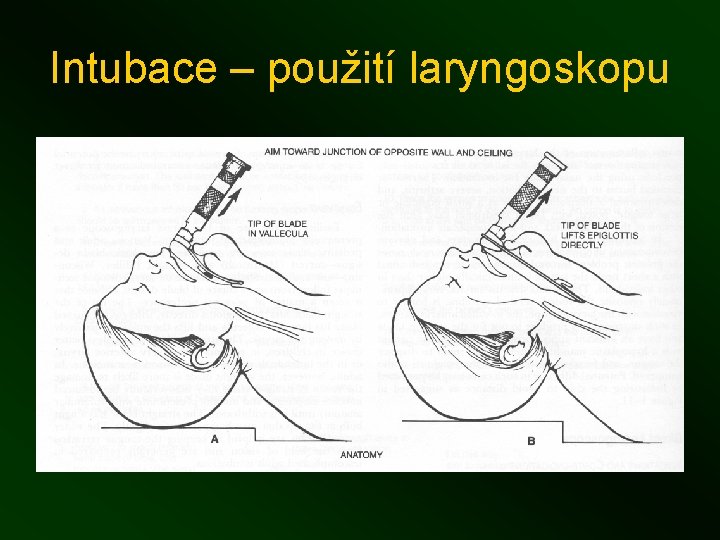 Intubace – použití laryngoskopu 