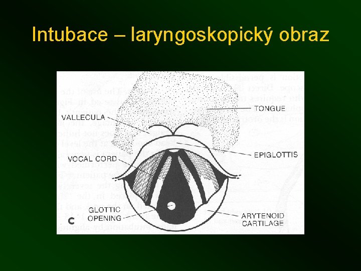 Intubace – laryngoskopický obraz 