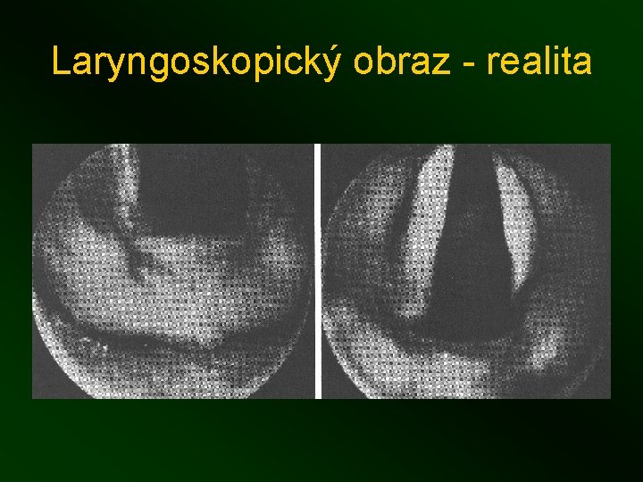 Laryngoskopický obraz - realita 