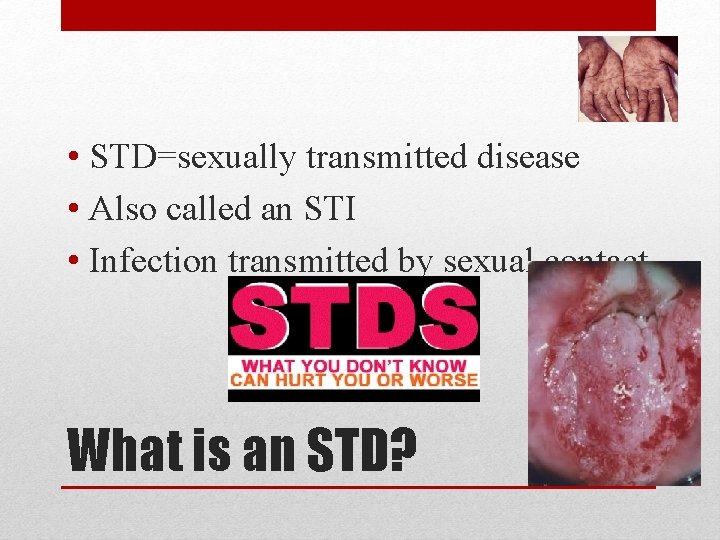  • STD=sexually transmitted disease • Also called an STI • Infection transmitted by