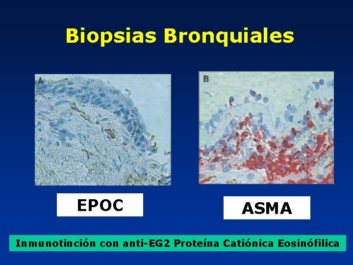 Biopsias Bronquiales EPOC ASMA Inmunotinción con anti-EG 2 Proteína Catiónica Eosinófilica 