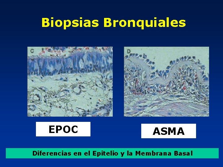 Biopsias Bronquiales EPOC ASMA Diferencias en el Epitelio y la Membrana Basal 